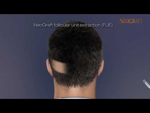 Animation on How NeoGraft® Works