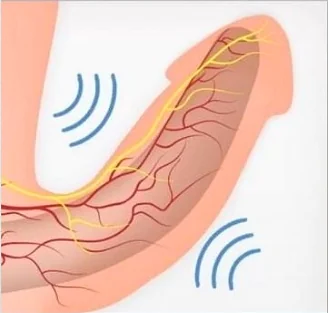 ED Wave Therapy