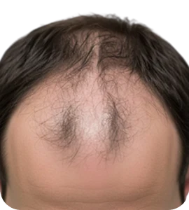 thinning hair