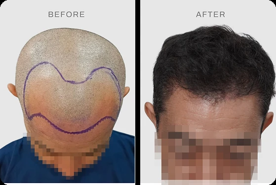 Hasil hair transplant pasien Jepang