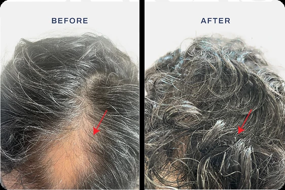 Hasil hair transplant pasien Singapura