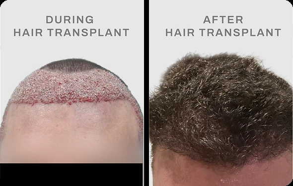 Hasil hair transplant pasien United Kingdom