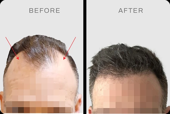 Hasil hair transplant pasien USA