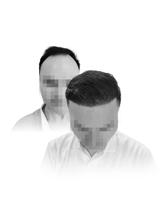 Hasil hair transplant pasien The Men's Clinic
