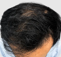 Norwood IV-VI setelah hair transplant