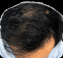 Norwood I-III & Vertex setelah hair transplant