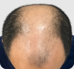 Norwood IV-VI sebelum hair transplant