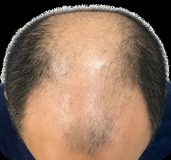 Norwood I-III & Vertex sebelum hair transplant