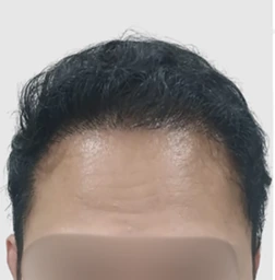 Norwood I-III & Vertex setelah hair transplant