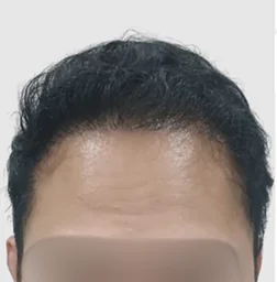 Norwood IV-VI setelah hair transplant