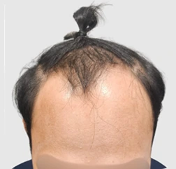 Norwood I-III & Vertex sebelum hair transplant