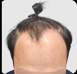 Norwood IV-VI sebelum hair transplant