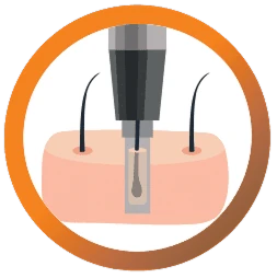Ekstraksi folikel dengan NeoGraft