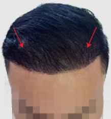 Receding hairline setelah hair transplant