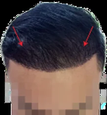 Receding hairline setelah hair transplant