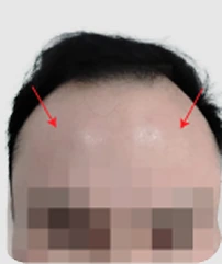 Receding hairline sebelum hair transplant