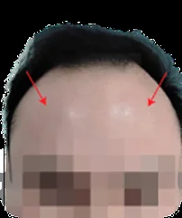 Receding hairline sebelum hair transplant