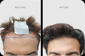 Before after hair transplant pasien TMC