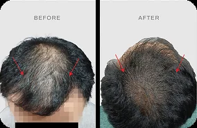Before after hair transplant pasien TMC