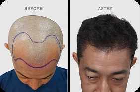 Before after hair transplant pasien TMC