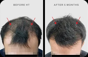 Before after 5 bulan hair transplant pasien TMC