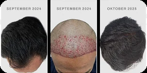Hasil hair transplant pasien TMC