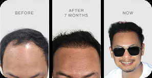 Hasil hair transplant pasien TMC
