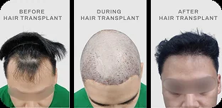 Before during after hair transplant pasien TMC