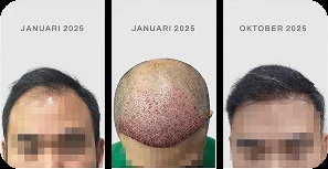 Hasil hair transplant pasien TMC