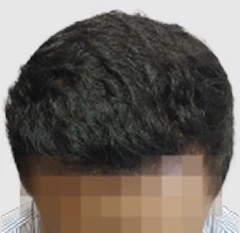 Hair thinning setelah hair transplant