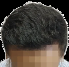 Hair thinning setelah hair transplant