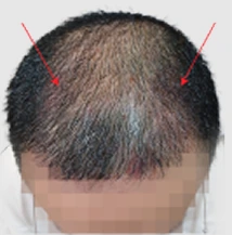 Hair thinning sebelum hair transplant
