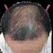 Hair thinning sebelum hair transplant