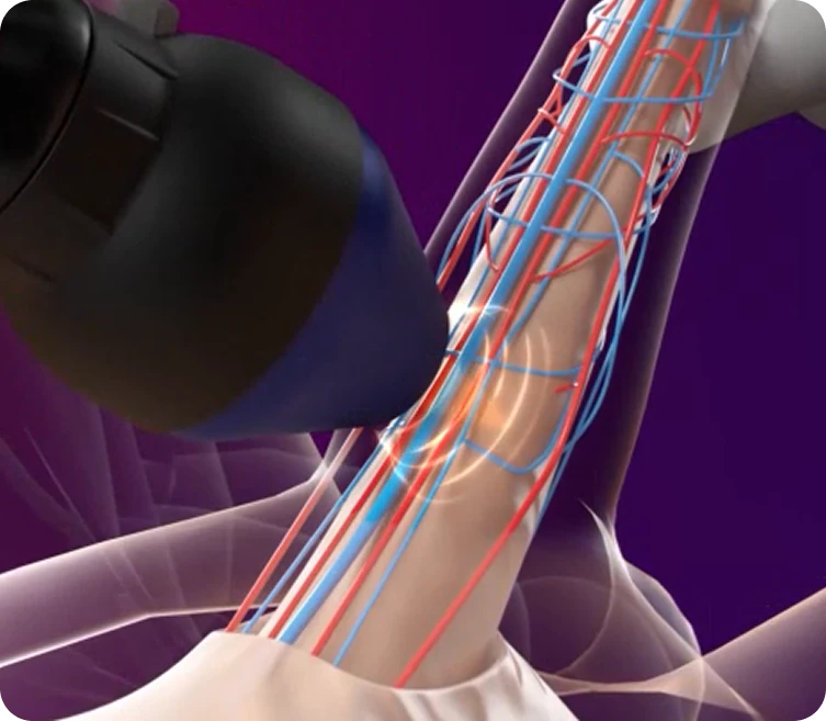 Kombinasi Penile PRP & ED Wave Therapy