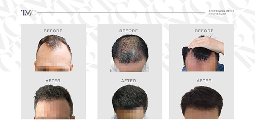 Before & after hair transplant