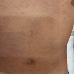 After laser hair removal