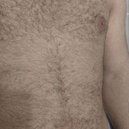 Before laser hair removal