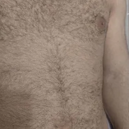 Sebelum laser hair removal