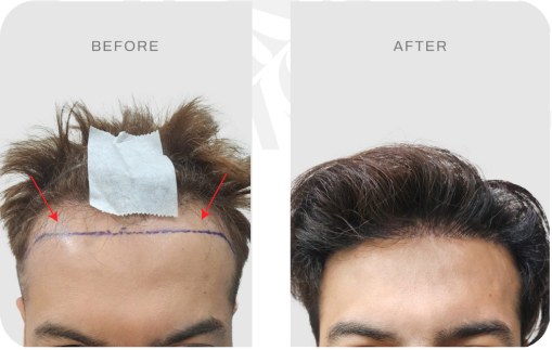 Before after pasien hair transplant