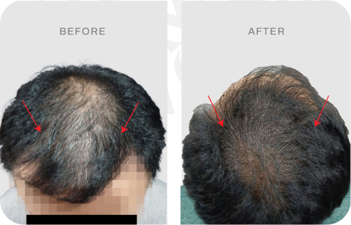 Before after pasien hair transplant
