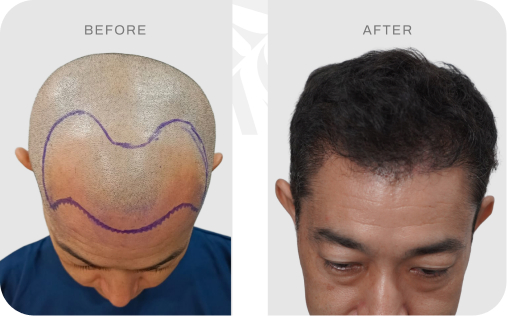Before after pasien hair transplant