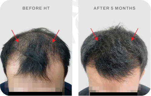 Before after pasien hair transplant