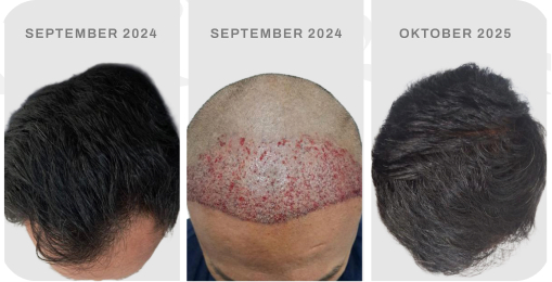 Before after pasien hair transplant