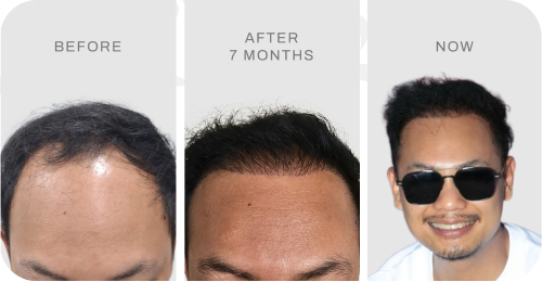 Before after pasien hair transplant
