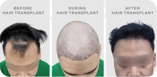 Before after pasien hair transplant