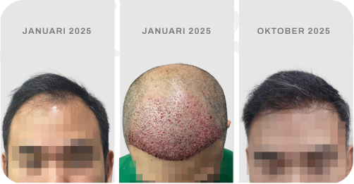Before after pasien hair transplant