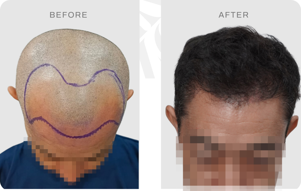 Before after pasien Japan