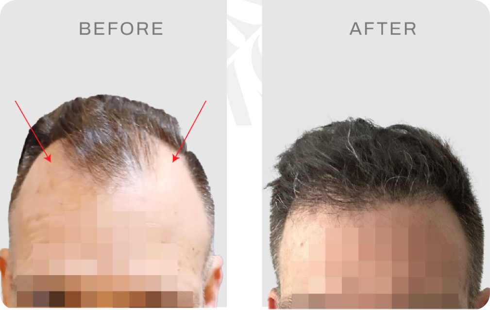 Before after pasien USA